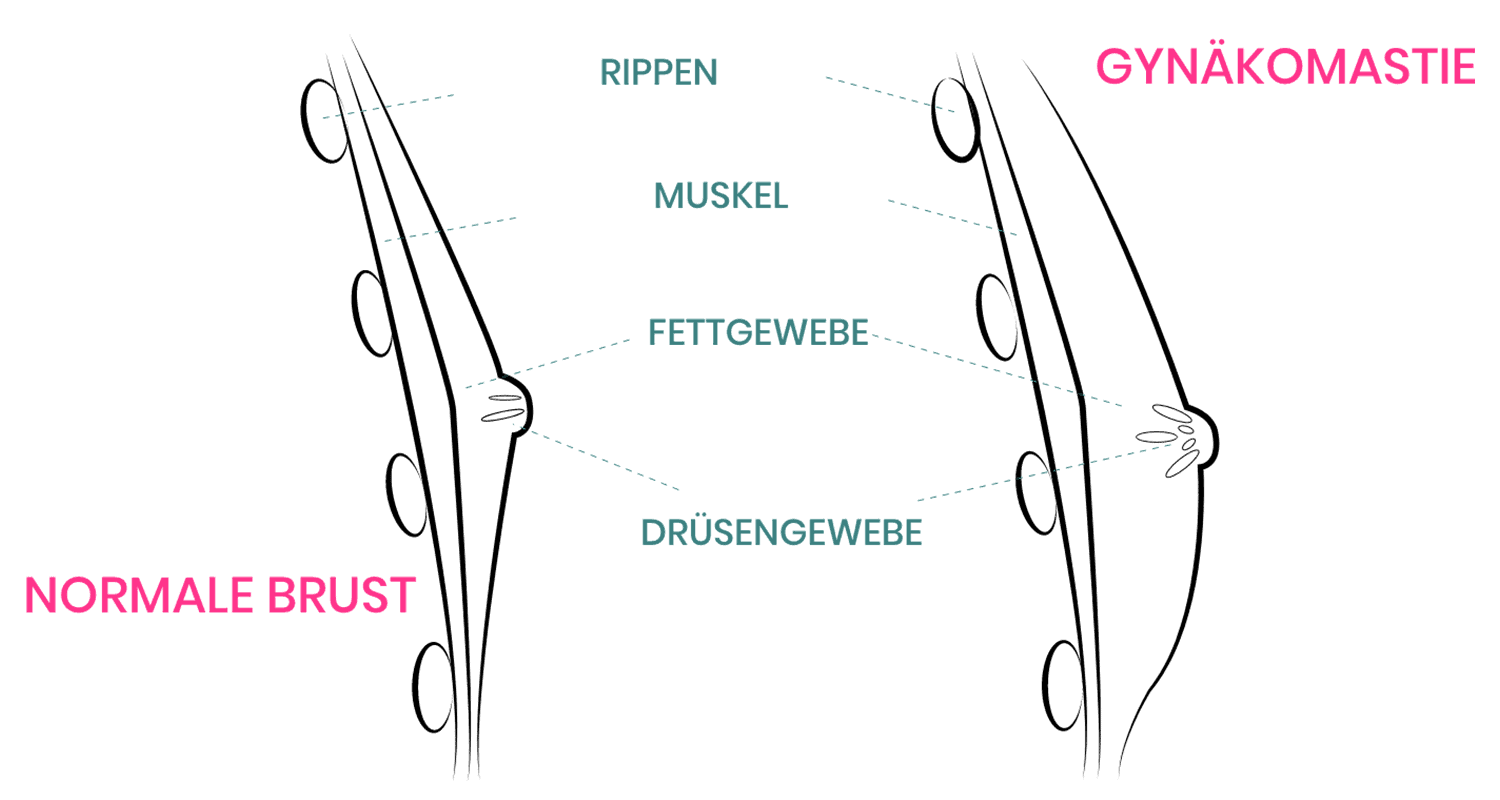 Gynäkomastie Operation