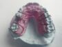 Kieferorthopädische Mythen entlarvt: Was Sie wirklich über Zahnspangen wissen sollten
